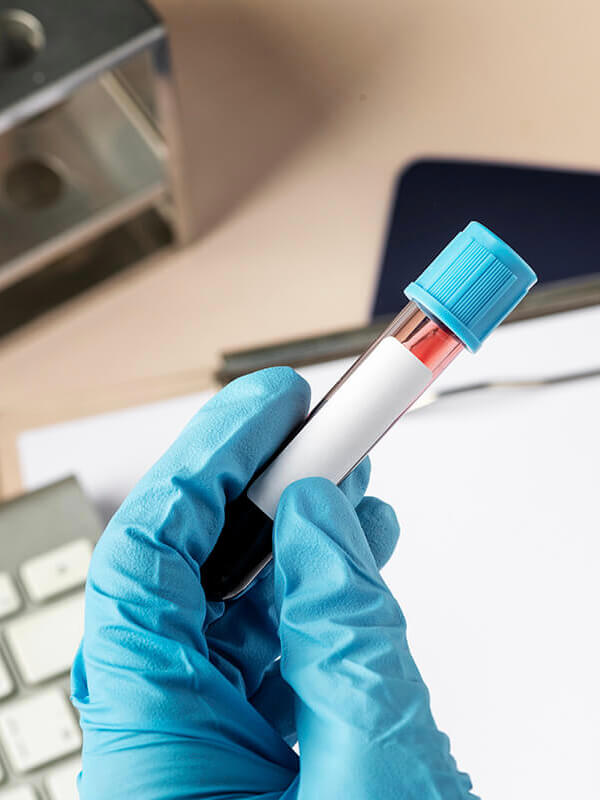 PSA test